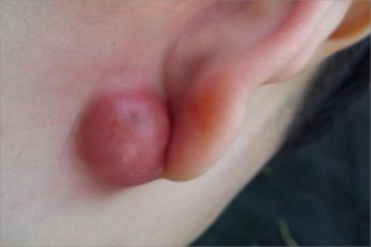 皮脂腺囊肿耳后红肿图