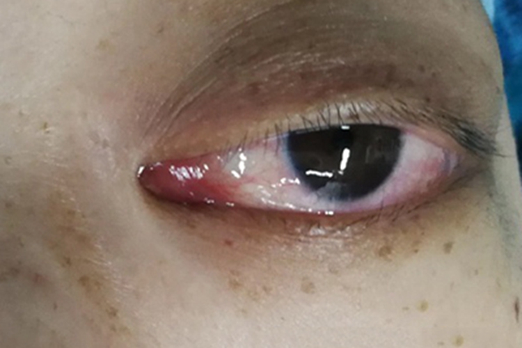 眼眶淋巴瘤眼球红肿图