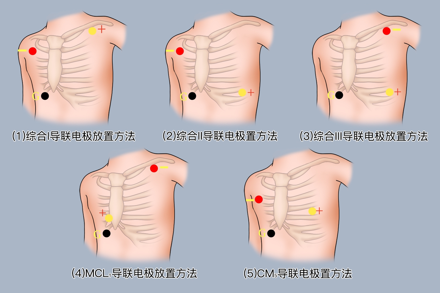 心电监测的电极位置图 心电监测的电极位置图
