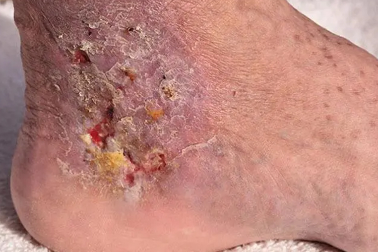 脚上蜂窝织炎图