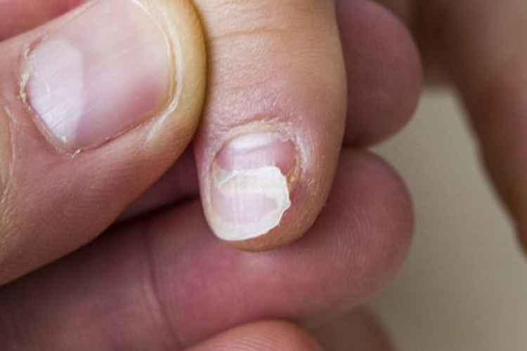 缺维生素B的指甲变脆图