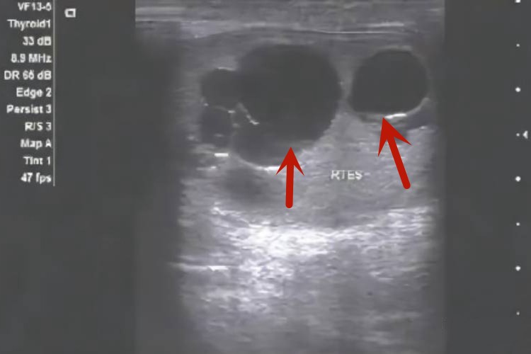 精液囊肿影像图