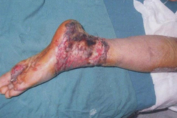 电弧烧伤脚踝糜烂图 电弧烧伤脚踝糜烂图