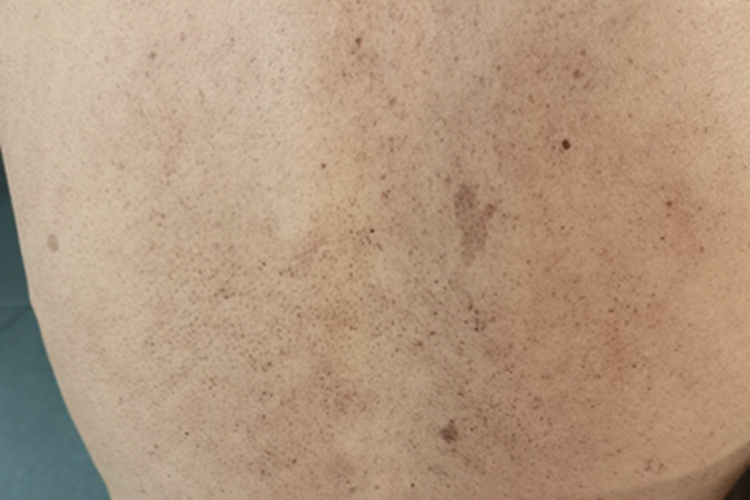 毛囊角化病背部症状图 毛囊角化病背部症状图