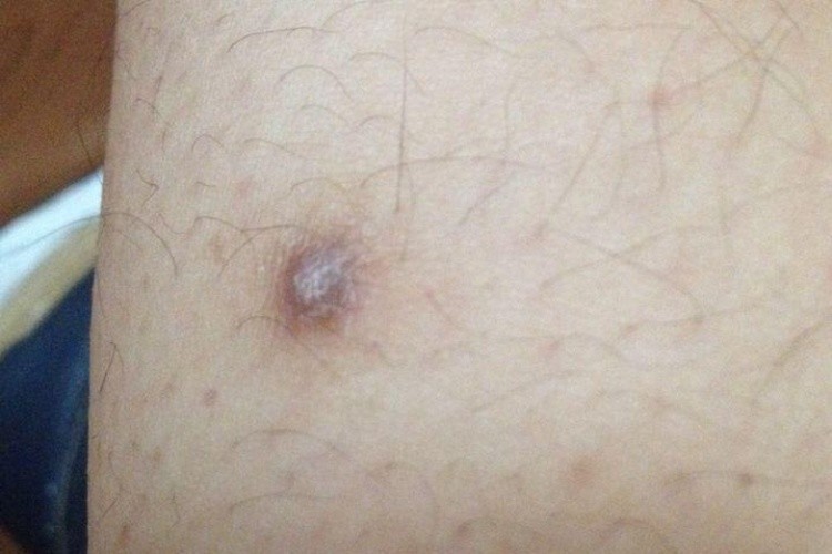 火疖子留下的增生性瘢痕图 火疖子留下的增生性瘢痕图