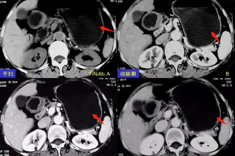 胃癌CT检查显示动脉期图