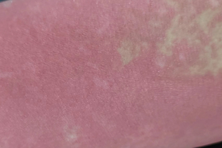 职业性光变应性接触性皮炎胳膊红肿图 职业性光变应性接触性皮炎胳膊红肿图