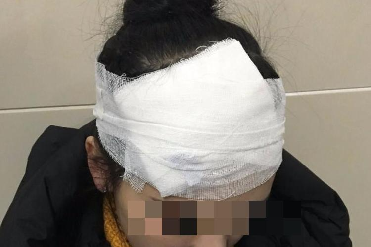 额头缝针后绷带包扎图 额头缝针后绷带包扎图