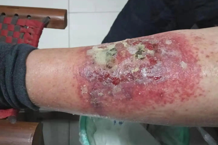 急性接触性皮炎图 急性接触性皮炎图