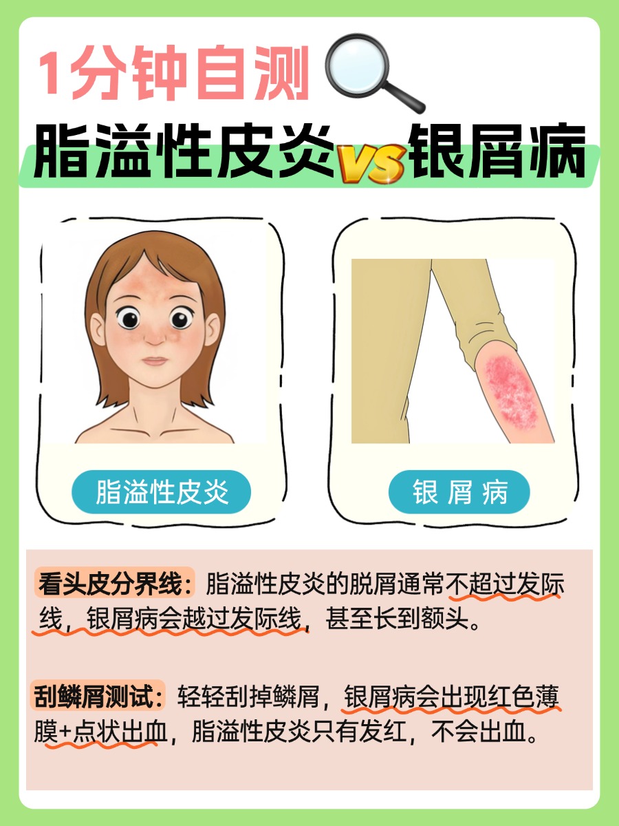 脂溢性皮炎和银屑病区分图!医生解疑
