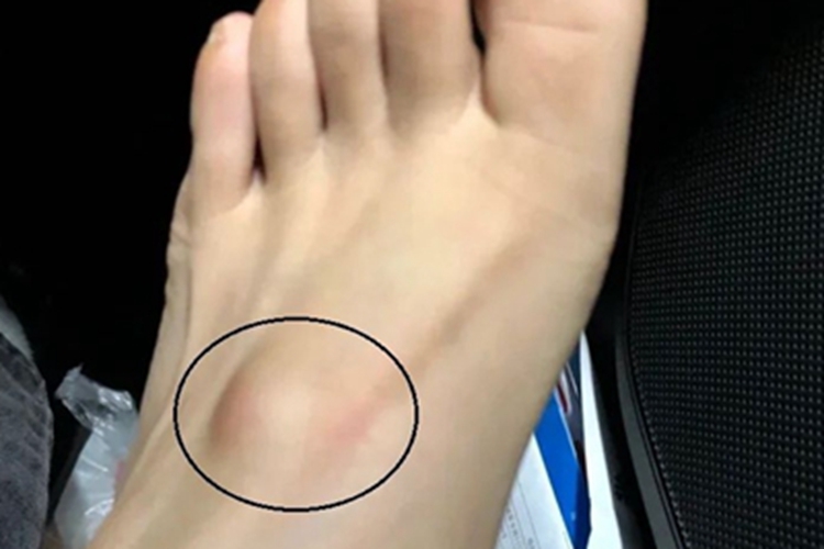 脂肪瘤脚背包块图 脂肪瘤脚背包块图