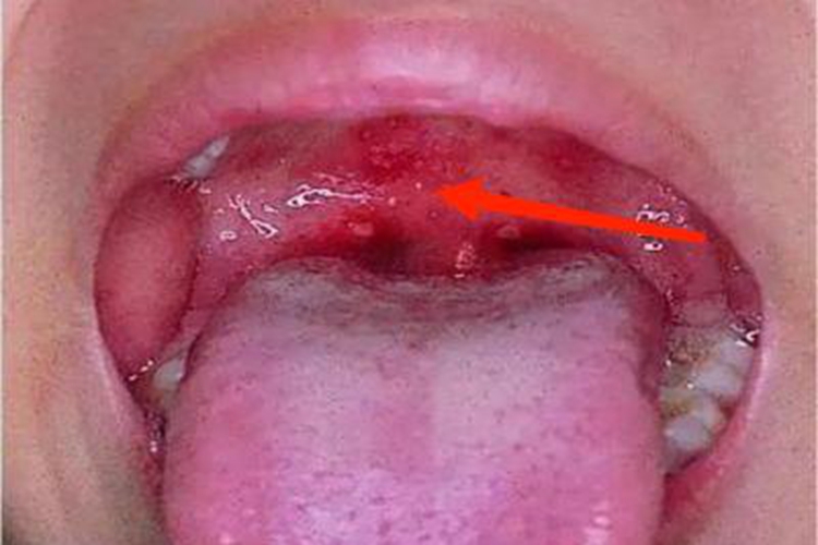 淋菌性咽炎咽后壁小水疱图