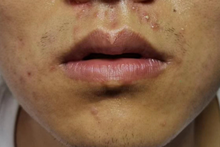 痤疮口周脓包图 痤疮口周脓包图