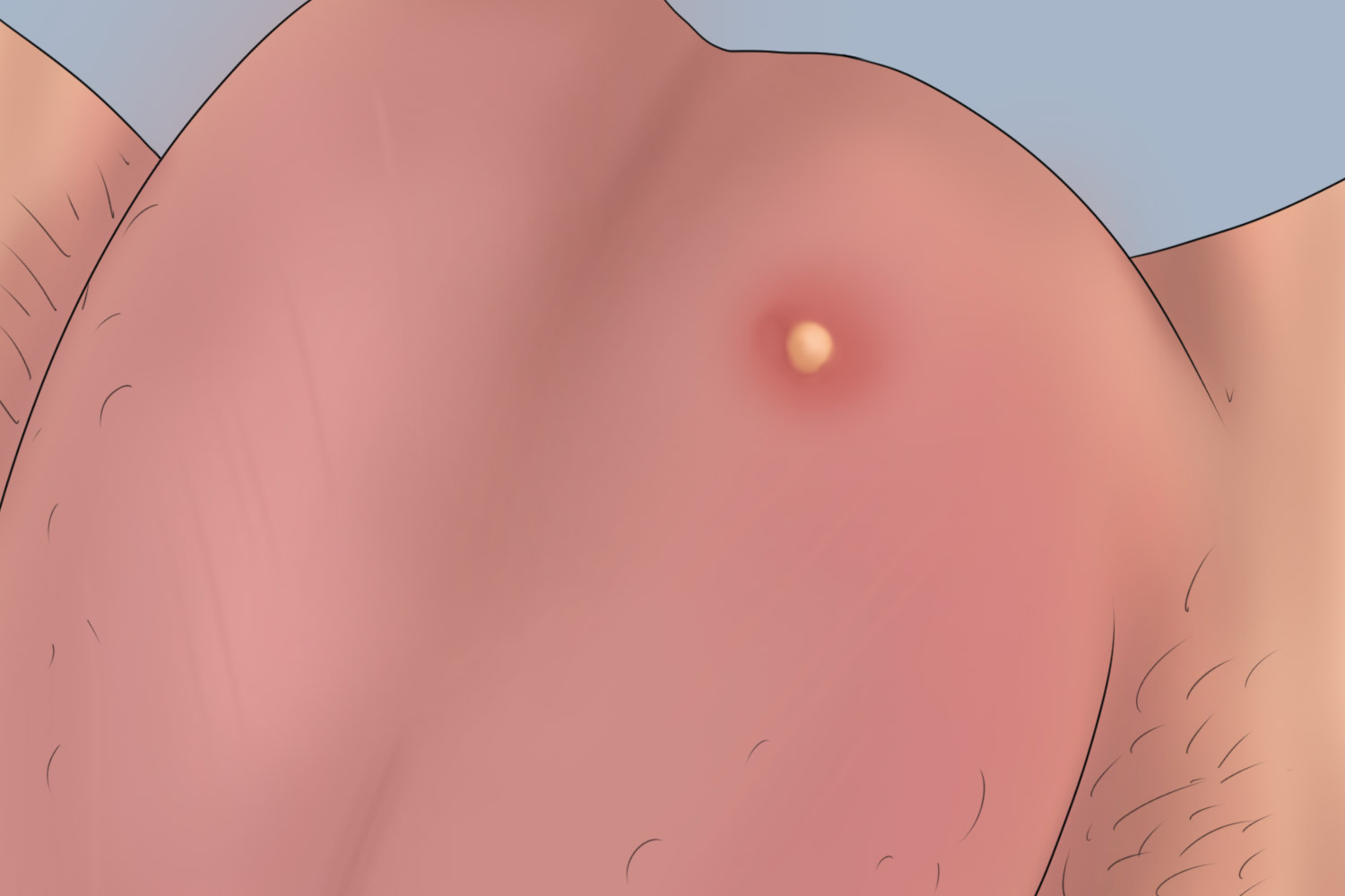 睾丸下面毛囊炎图