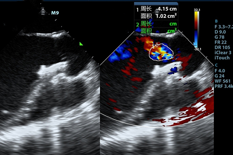 房间隔缺损彩超图