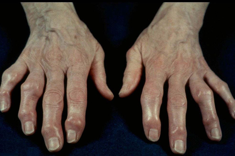手指增生图 手指增生图