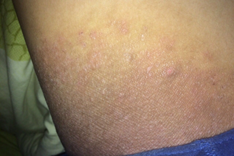 股癣大腿根颜色加深起疙瘩图 股癣大腿根颜色加深起疙瘩图