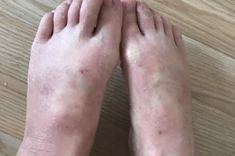 接触性皮炎脚背脱皮图