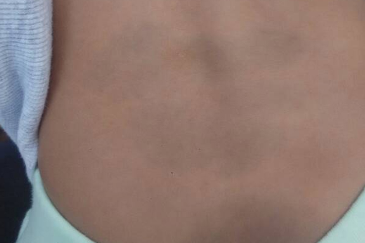 宝宝背上青色胎记图