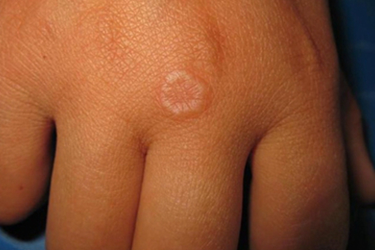 手部环状肉芽肿图