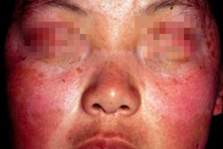 原卟啉病症状图 原卟啉病症状图