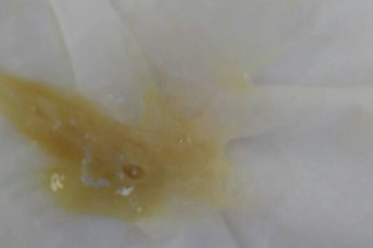 急性鼻窦炎流脓涕图