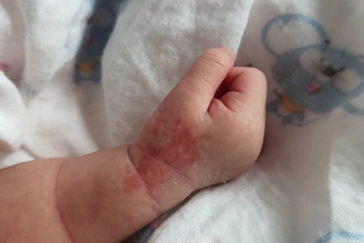 红斑狼疮手背症状图