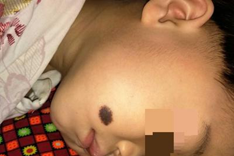 复合痣面部症状图