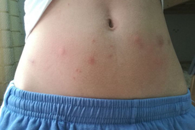 跳蚤叮咬腹部疙瘩图 跳蚤叮咬腹部疙瘩图