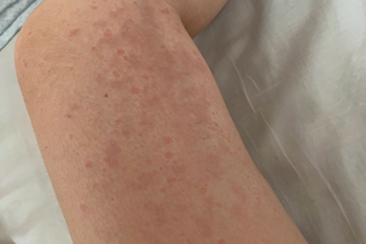 亚急性接触性皮炎大腿症状图