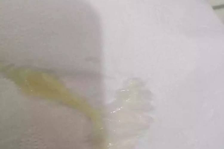 滴虫性阴道炎分泌物发黄图 滴虫性阴道炎分泌物发黄图