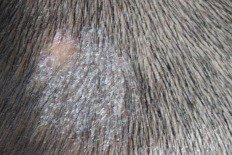 儿童头部白癣图