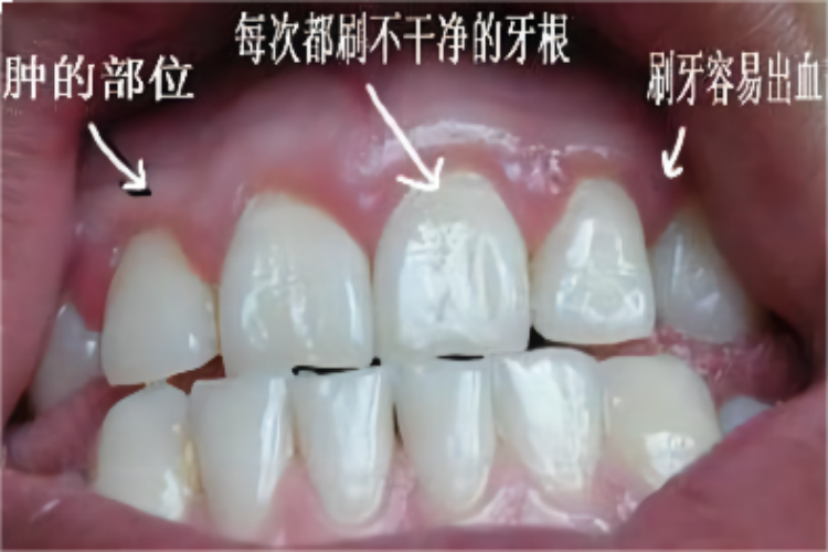 牙龈炎牙床鼓包图