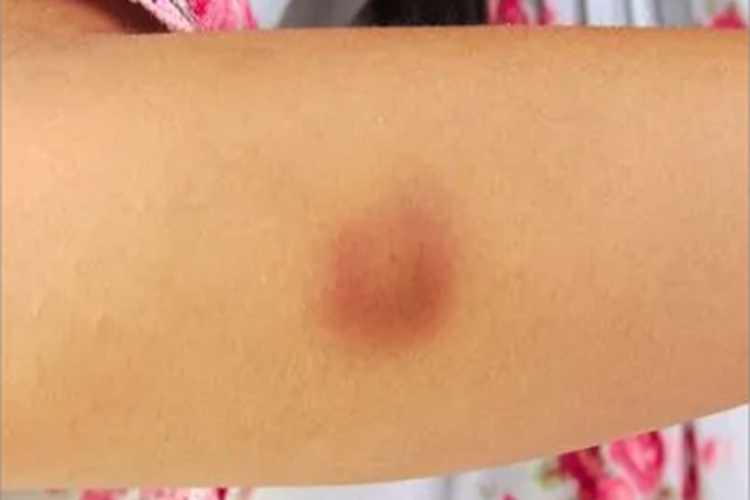 皮下脂质肉芽肿病大红疙瘩图 皮下脂质肉芽肿病大红疙瘩图