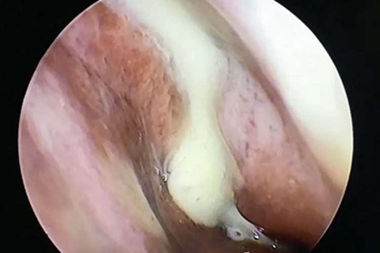 急性化脓性鼻窦炎鼻腔鼻涕图