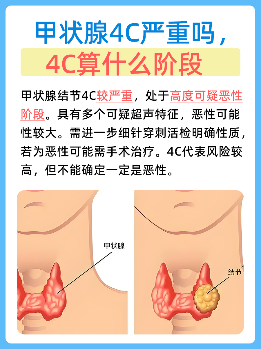 探究：甲状腺4C严重吗，4C算什么阶段