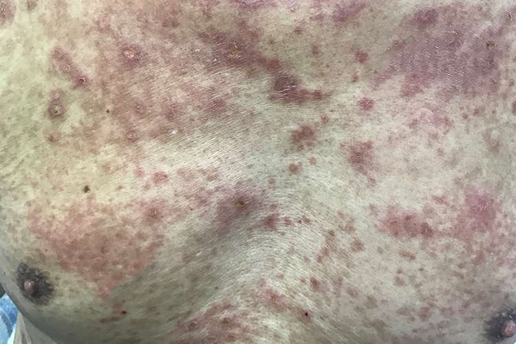 亚急性湿疹图 亚急性湿疹图