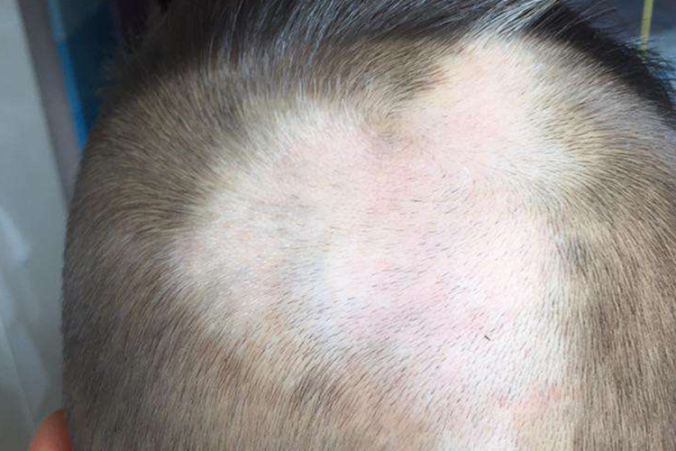 白癜风宝宝头皮上有白斑图