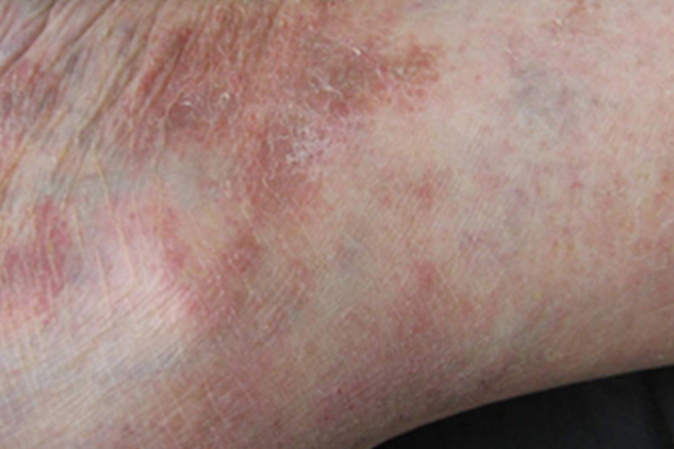 色素性紫癜性苔藓样皮炎脱屑图 色素性紫癜性苔藓样皮炎脱屑图