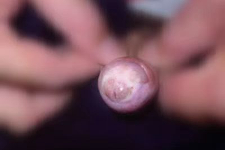 闭塞性干燥性龟头炎皮肤颜色变浅图