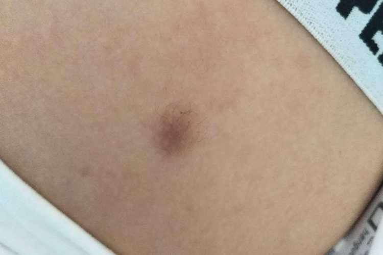 背部皮肤纤维瘤图 背部皮肤纤维瘤图