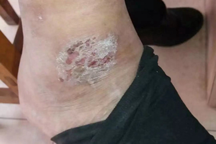 慢性湿疹脚踝症状图 慢性湿疹脚踝症状图