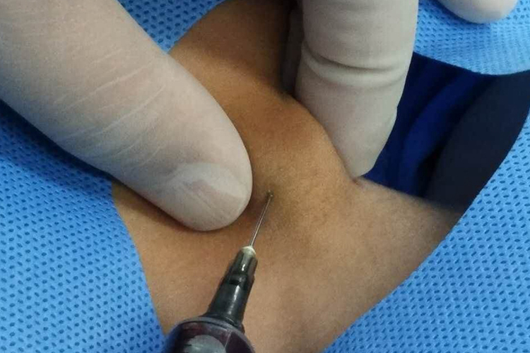 儿童淋巴结穿刺图