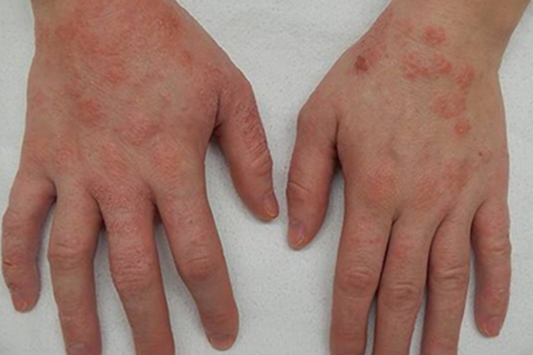艾滋病感染性皮肤损害手背丘疹图