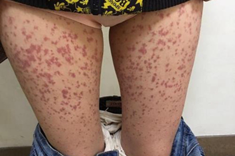 过敏性紫癜大腿症状图 过敏性紫癜大腿症状图
