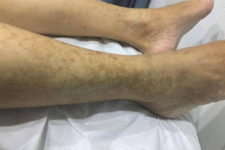 典型麻疹恢复期小腿症状图 典型麻疹恢复期小腿症状图