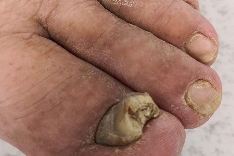 甲癣脚趾甲变形拱起图
