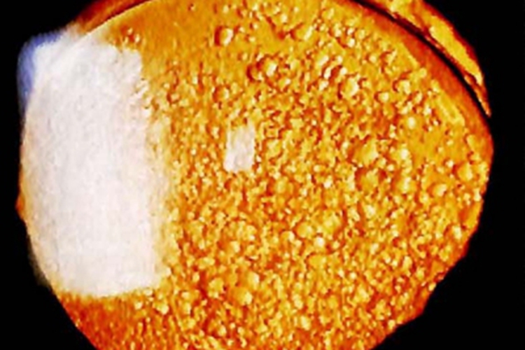 后发性白内障眼球小水疱图 后发性白内障眼球小水疱图