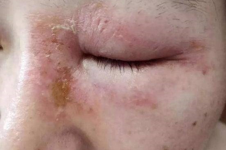 虫咬皮炎面部黄痂图
