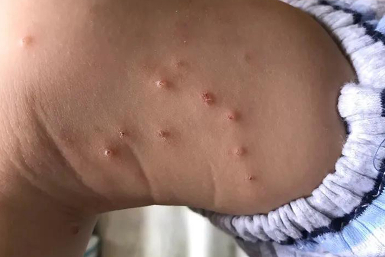 腿部传染性软疣图 腿部传染性软疣图